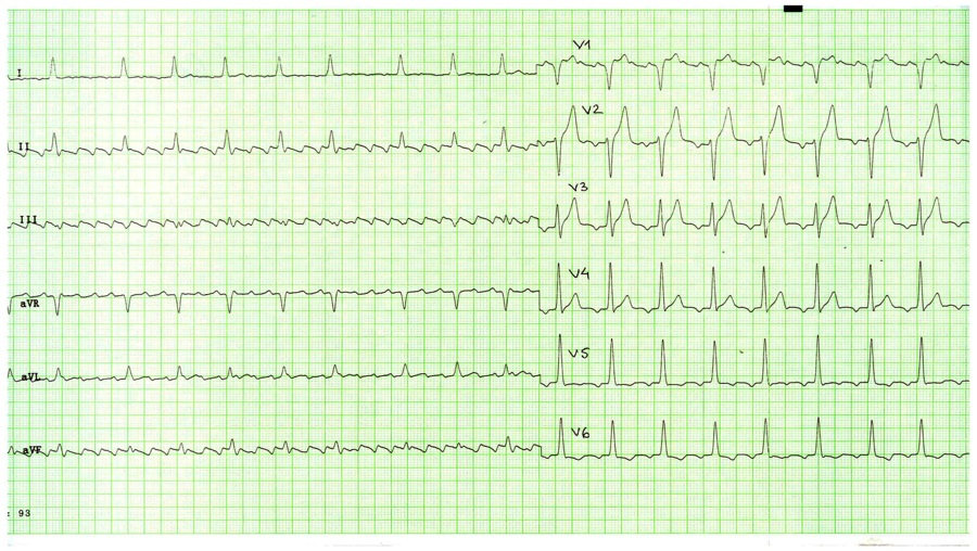 FLUTTER ATRIAL FIBRILATIA ATRIALA (fa): Unde «f» atriale neregulate, cu frecventa medie intre 400 si 600 / minut, conduse la ventriculi tot in mod neregulat, cu o