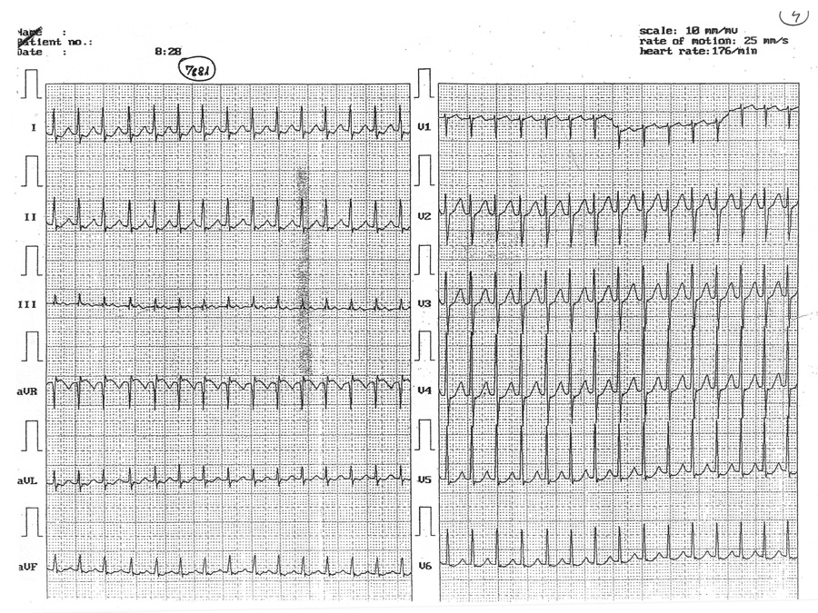 TAHICARDIE PAROXISTICA SUPRAVENTRICULARA TAHICARDIA PAROXISTICA VENTRICULARA (TPV): Sir de cel putin trei complexe QRS, cu morfologie si axa diferite de cele ale complexelor QRS de origine sinusala,