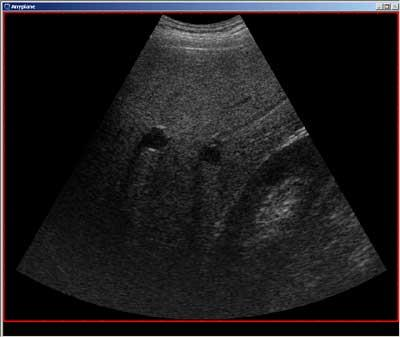 Fettlever (steatosis hepatis) Akkumulasjon av fettdråper i hepatocyttene gir et bilde preget av hyperekkogenisitet (figur 7) og attenuasjon (svekkelse av ultralydbølgene med økende vevsdybde).