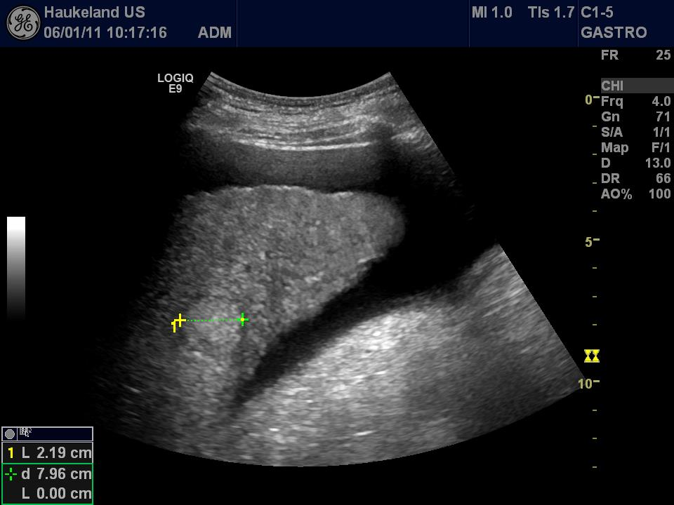 caudatus og venstre lobe. Tegn på portal hypertensjon som utvidet diameter av vena porta (>13 mm), splenomegali, collateraler, varicer og ascites er også viktig å vurdere.