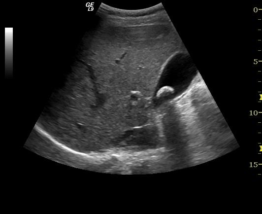 Vanlig sonopatologi i galleblære og galleganger Ultrasonografi er den beste diagnostiske metoden ved sykdommer i galleblære og galleveier.