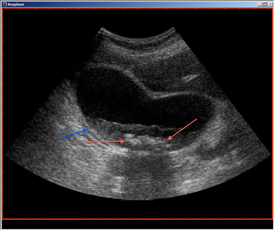 Andre tegn er pericholecystiske væskeansamlinger og absesser, samt hyperemi i galleblæreveggen visualisert med fargedoppler.