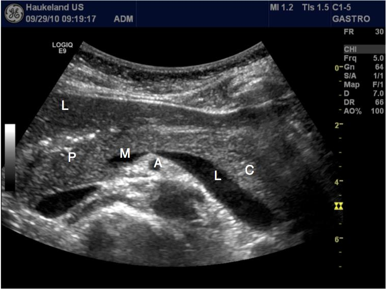 Vanlig sonopatologi i pancreas Pancreas (Figur 17) ligger retroperitonealt, og størrelse og form varierer betydelig fra person til person.