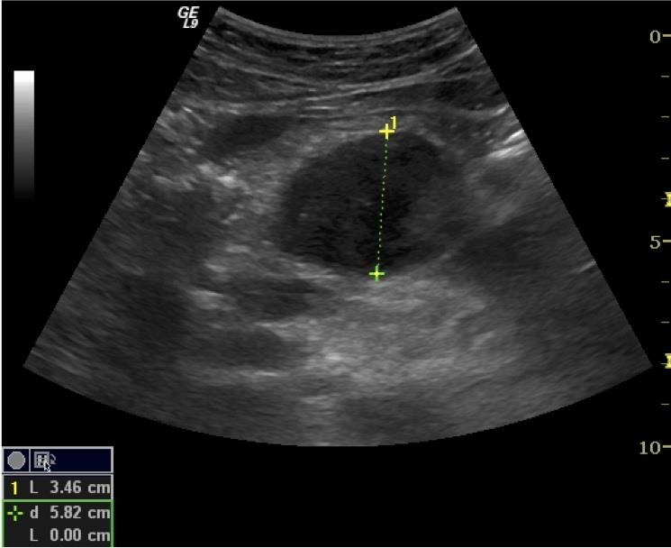 Pancreas cancer Ultrasonografisk ser cancer ut som en hypoekkogen prosess (figur 21), ofte med pseudopoder som invaderer omliggende vev.