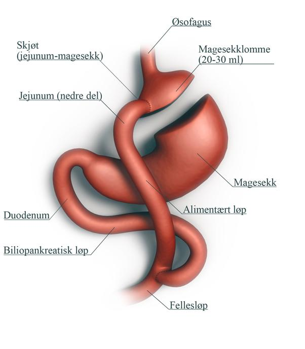 Figur 4: Mage- og tarmkanalen etter gastric bypassoperasjon. Utarbeidet av illustratør Fredrik Arntzen og KEF Rose-Linn Bø.