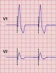 Merke en hendelse CardioPerfect Workstation Når du oppdager en hendelse, som et arytmi under opptak, kan du merke dette i EKG.