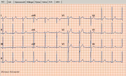 4.2 Visningsformater Welch Allyn Cardio Perfect tilbyr flere forskjellige visningsformater for EKG. Hver visning tar for seg forskjellige aspekter av EKG.