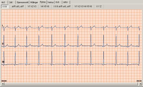 Rytmevisning Hvis du har tatt et rytme-ekg, kan du se hele EKG i rytmevisningen. Du kan bruke blafeltet for å se gjennom hele EKG.