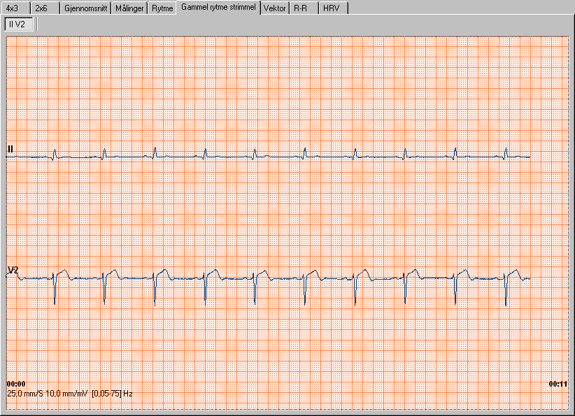 Gammel rytmestrimmel visning av gammel rytmestrimmel er kun tilgjengelig for EKG tatt med tidligere versjoner av Workstation (før 2000). Det viser den opprinnelige II V2 rytmestrimmelen.