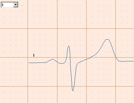 4.8 Angi arkhastighet og sensitivitet CardioPerfect Workstation Welch Allyn Cardio Perfect tilbyr flere hastigheter og sensitiviteter.