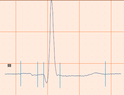 4.12 Bruke støyfilter EKG-kurvene kan inneholde støy forårsaket av forstyrrelser fra strømnettet. Dette gjør kurvene vanskeligere å tyde. Du kan filtrere bort støy ved å bruke nettstrømfilter.