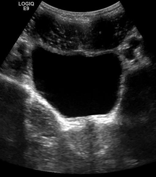 h*b*l/2 Prostata: Størrelse 2,5*3*3,5cm Uterus Skannes transversalt og