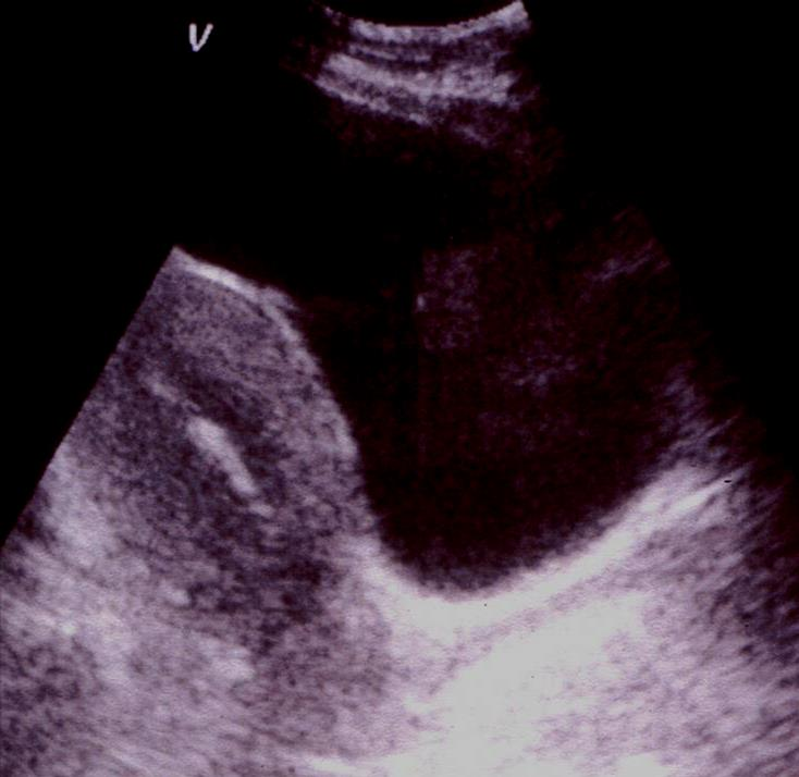 Ovarier Størrelse 1*2*3cm Kan forveksles eller ligge gjemt mellom