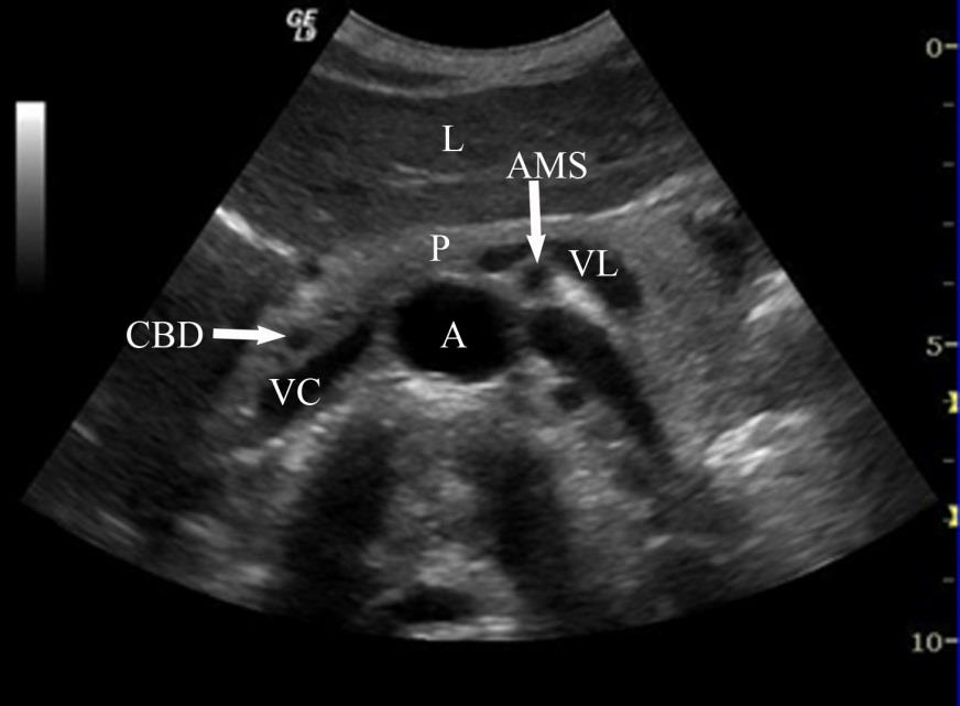 Stasjon 1 Transversalsnitt i epigastriet Kjente anatomiske landemerker til orientering: Aorta, vena cava, art. mesenterica superior, pankreas og lever.