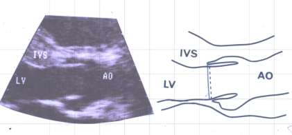 Arealberegning ved kontinuitetslikningen V 1 V 2 LVOT-diameter