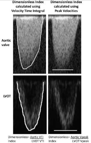 Repetert oppfølgning av pasienter: Dimensjonsløs indeks, hastighet eller gradient Maksimalhastighet i LVOT og stenosen er mest