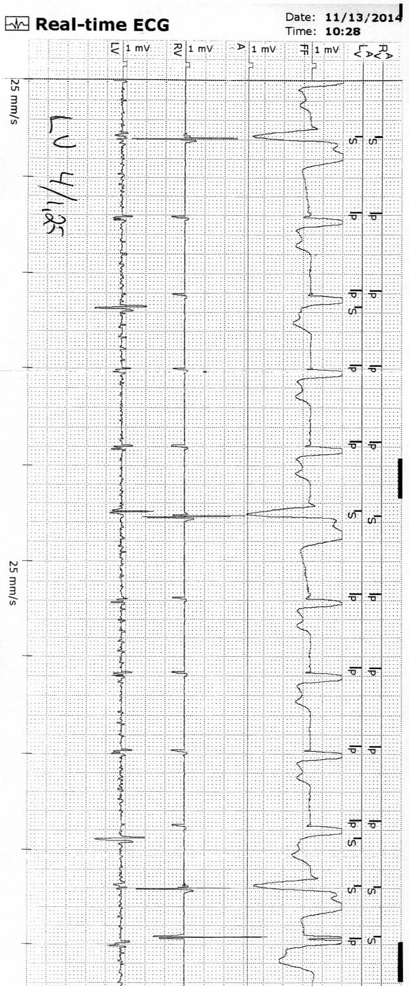 Figur 2. Intermitterende loss of capture på LV-ledningen. Trådløst EKG er likt i slag med og uten LV- En senllv-sens avslører slagene der venstreledningen ring). En sen LV- sens Figur 2. capture. Intermitterende oss of capture på Lde V- ledningen.