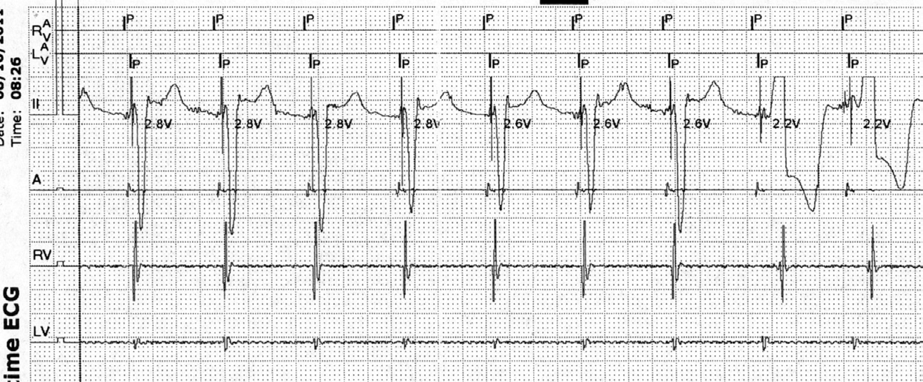 2,2 V 2,8 V Tidlig/simultan RV- sens Smalt QRS Sen RV- sens Bredt QRS Figur 3Figur. Anodal timulering. Terskeltest dterskeltest er det kun paces å LV- ledningen til RV- ring.