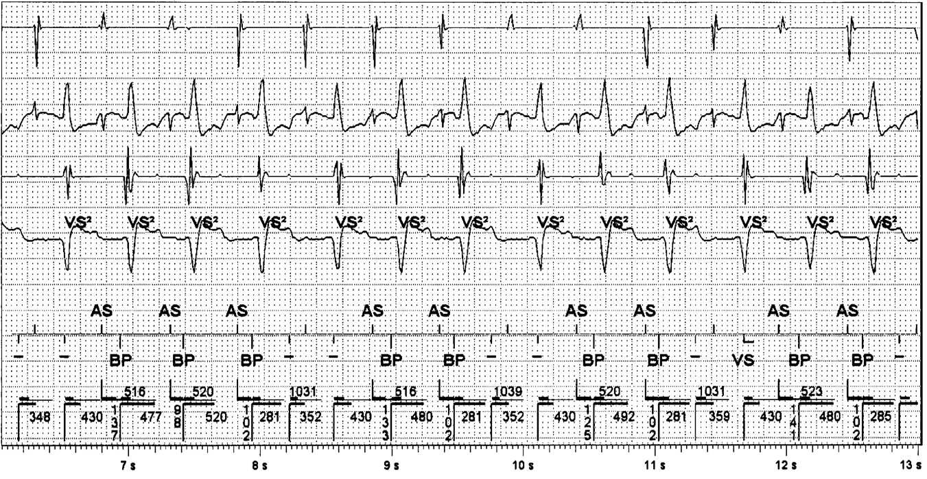 A- EGM Leadless ECG V- EGM Discrimination (FF- EGM) T- wave oversens - TWOS Markører Figur 5. T-bølge oversens (TWOS) kan gi tap av biventrikulær pacing.