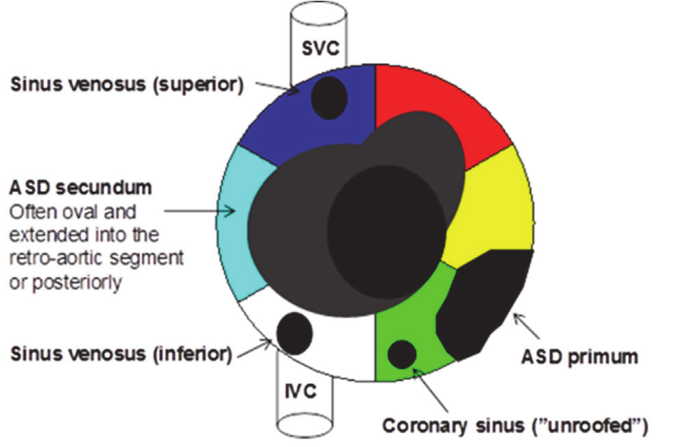 In most cases transthoracic and transesophageal echo are sufficient to map the anatomy. Sometimes, contrast-echo with agitated saline helps to demonstrate the inter-atrial communication.