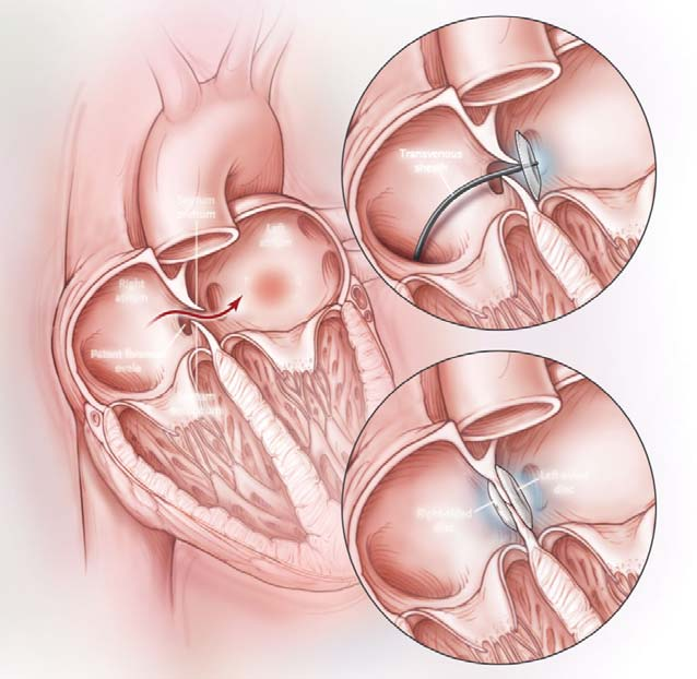 Åpen foramen ovale