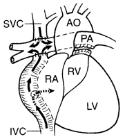 6 Fontan-opererte (TCPC= Total Cavo Pulmonal Connection) Hemodynamikk Ekko-Doppler Palliativ prosedyre.