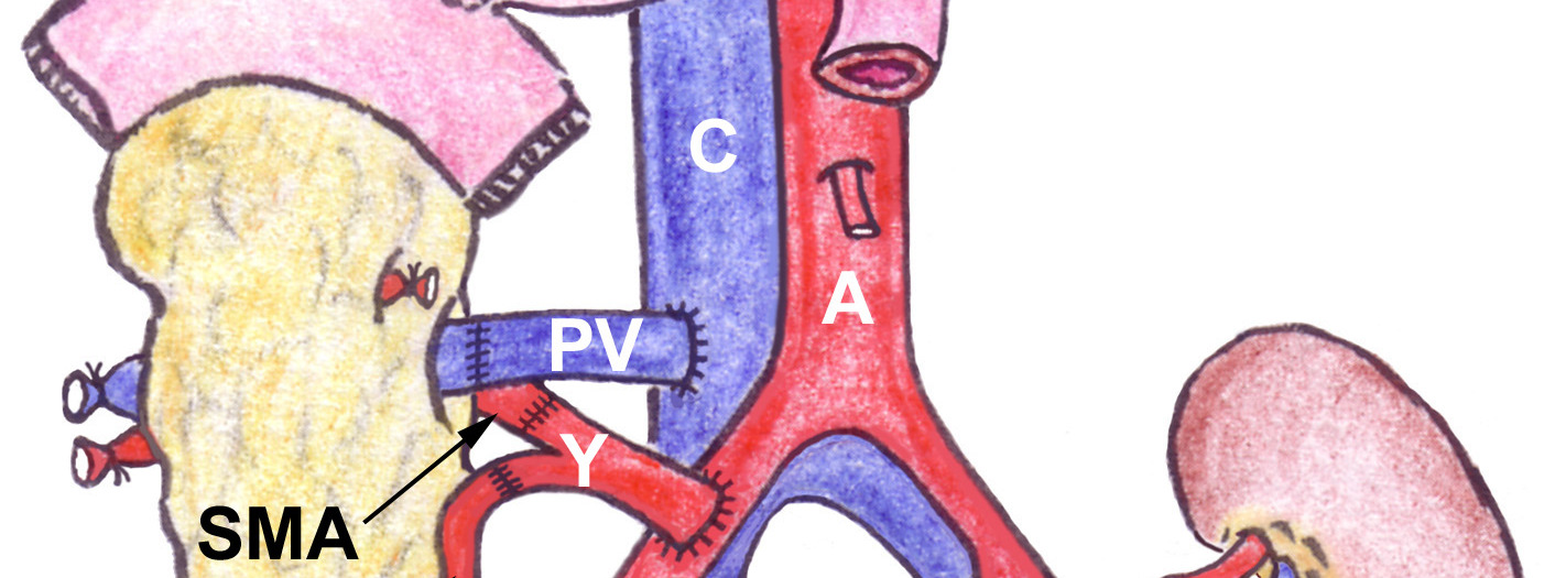 Tx-duodenum Jejunum Tx-Kidney anastomoses: