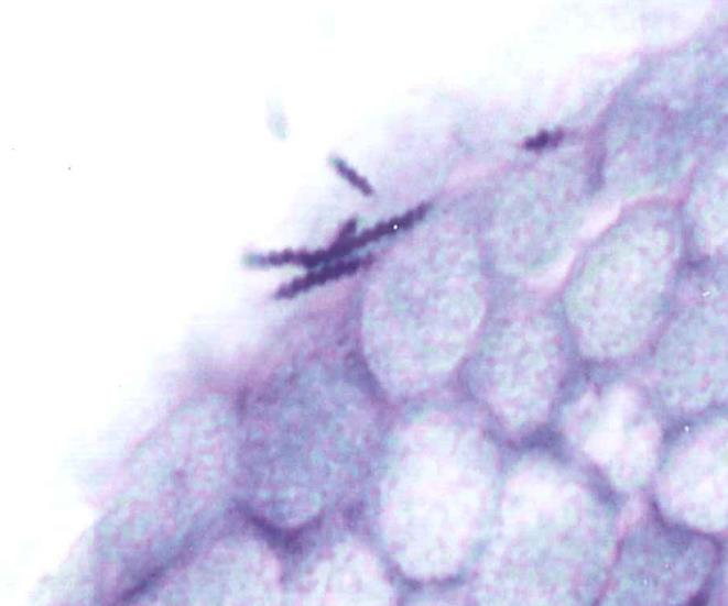 Helicobacter - relatert gastritt H.Pylori H.Heilmanii ( sjelden, <1% av tilf.) Samme klinikk og histologi.