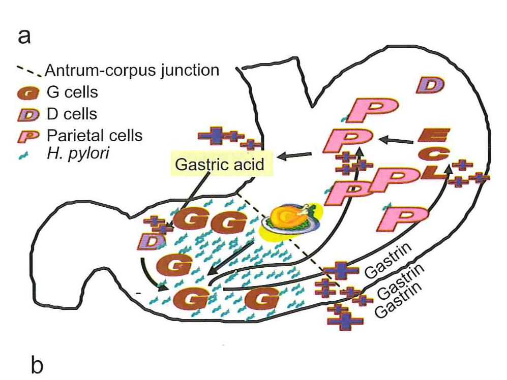 Tidlig stadium i HP-gastritt I denne fase økt G-prod. ved måltider og andre stimuli, gir økt HCL-produksjon.