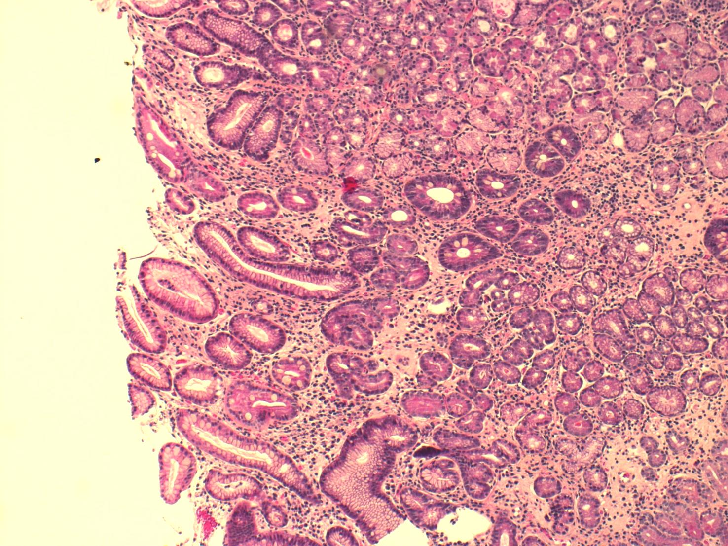 Intestinal metaplasi