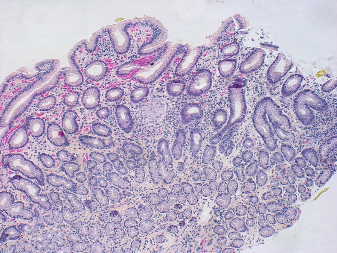 GRANULOMATØS BETENNELSE Crohns sykdom Sarkoidose