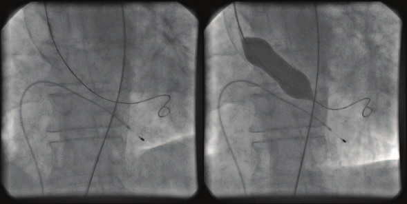 Ballong-valvuloplastikk av aortaklaffen som bro til annen behandling - illustrert ved tre kasuistikker Eystein Skjølsvik¹, Rolf Busund², Børge Schive¹ og Terje Steigen¹.