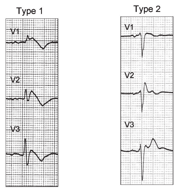 Figur 3. Type 1- og type 2-EKG ved Brugadas syndrom ( fra Wikipedia) Figur 4. Retningslinjer for ICD-behandling hos Brugadapasienter. Basert på Priori SG et al. Heart Rhythm.