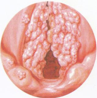 området rundt stemmebåndene, i larynks (strupen) og trachea (luftrøret). I sjeldne tilfeller kan det også dannes i lungene.