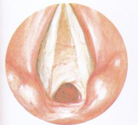 (Ciba, 1964, s. 79) Figur 8 Web 3.7 Cyster Cyster er godartete utvekster på stemmebåndene. De er gjerne væskefylte, og oppstår som regel enkeltvis.