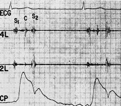 Figur 3. A. Auskultasjonsfunn illustrert ved phonokardiografi. Phonokardiografi hos 23-årig mann med mitralprolaps syndrom.