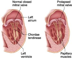 mitralprolaps var at en eller begge hoveddelene av klaffen gikk innover i venstre atrium. I 1980-tallet brukte Pivotal tredimensjonal ekkokardiografi og redefinerte mitralklaffens anatomi 11.