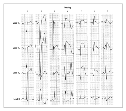 ST-elevasjon under sykdom vvh lbbb aper hkal STEMI