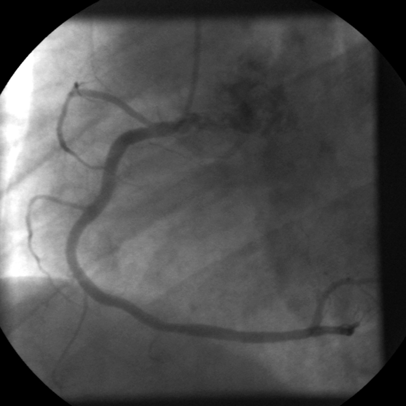 Figur 4. Figur 5. Intravaskulær ultralyd (IVUS) Angiografi har klare begrensninger i vurdering av stenoser (eksentriske stenoser, overprojeksjon av kar, bifurkasjoner) og utbredelse av aterosklerosen.