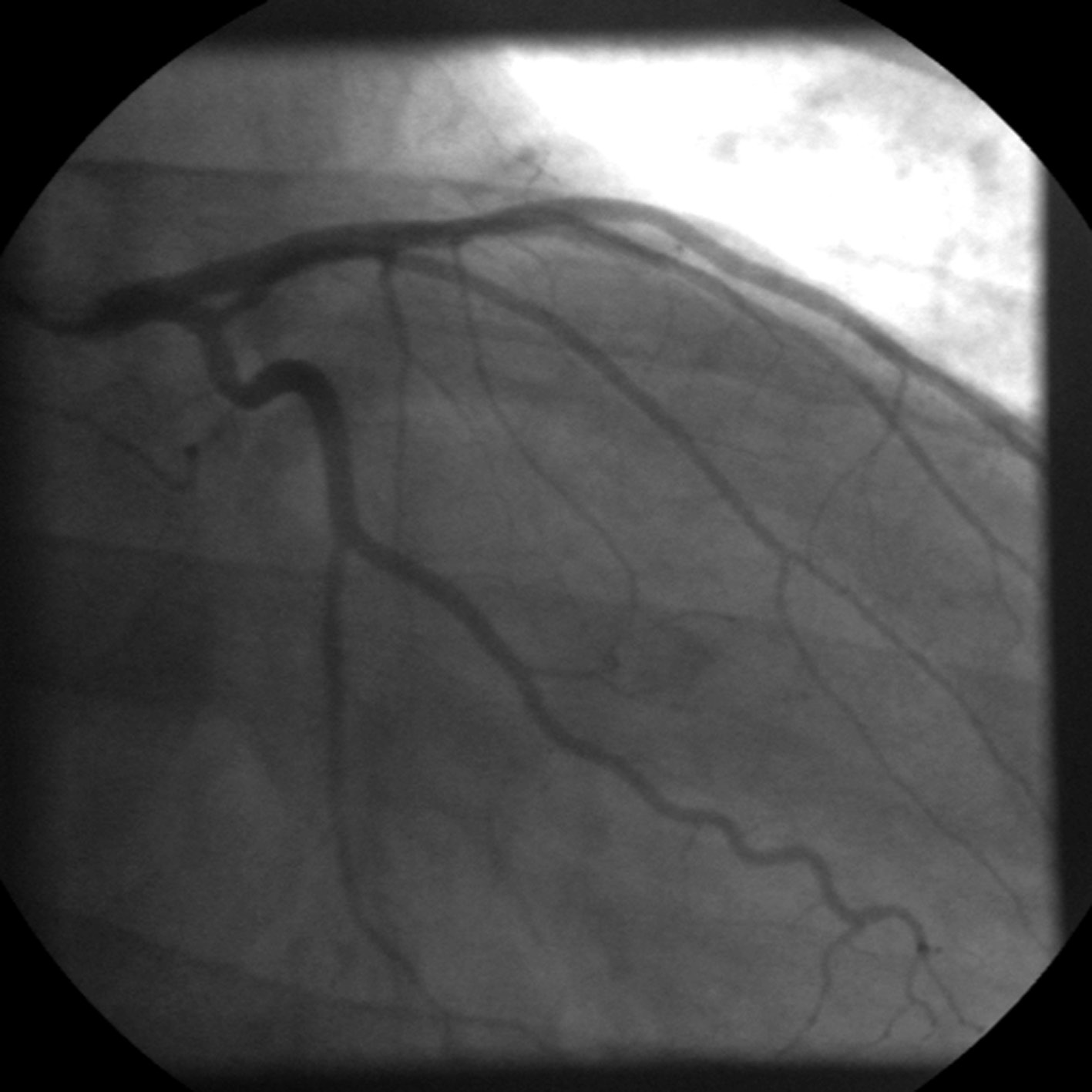 Ultralydtransduseren er montert på enden av et tynt kateter (diameter 2,9 Fr/ 0,9 mm), som føres inn i en arterie over en guidewire under gjennomlysning og injeksjon av kontrast.