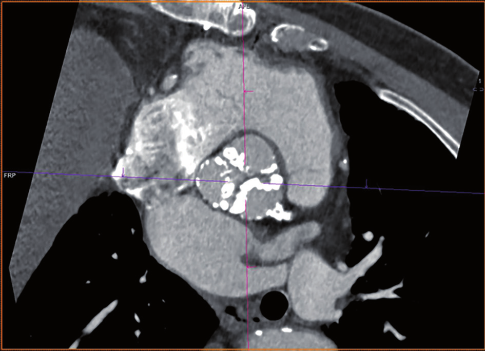 Figur 7 a Figur 8 a: CoreValve Evolut R selvekspanderende perkutane aortaklaff, b: Edwards Sapien 3 ballongekspanderbare perkutane aortaklaff, c: Lotus mekanisk ekspandert perkutane aortaklaff Flere