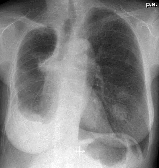 Startet behandling med gefitinib. Start Etter 4 uker Etter 8 uker Stabil 5 år.