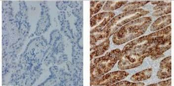 IHC med mab mot mutert EGFR (del exon19) ved NSCLC Vanskelig å etablere i