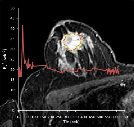 Figur 4-11: Illustrasjon av den temporale transversale relaksasjonsraten i en 38 år gammel kvinne med invasivt duktalt karsinom (IDC).