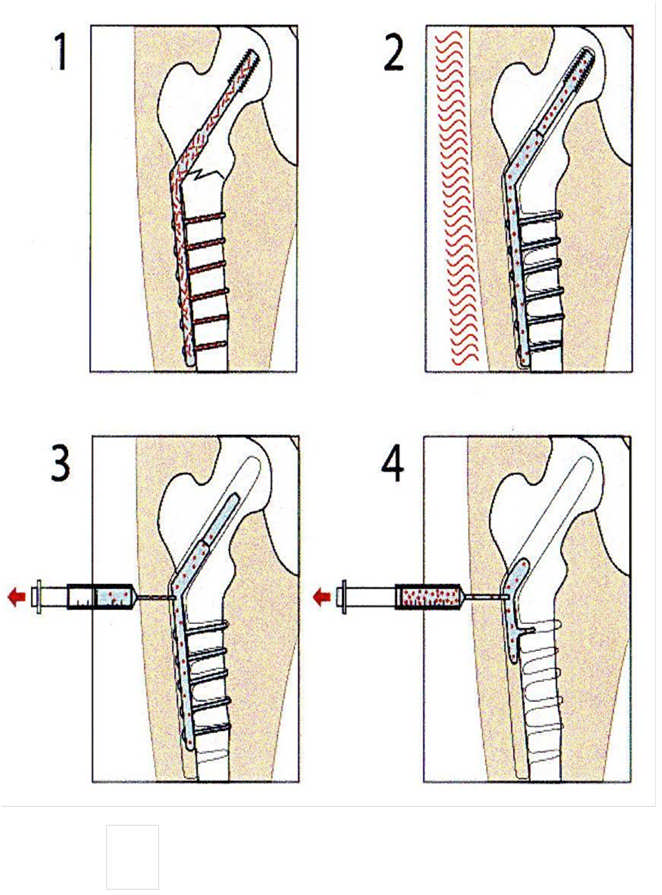 7RP R4S: FRACTFIX Main SME Indosynt AS: Works generally towards the medical industry, and was established to develop and commercialise a new type of material for surgical use in traumathology.