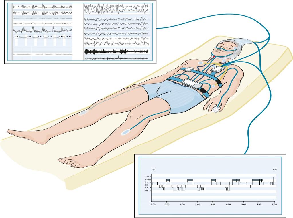 Polysomnografi ved utredning av søvnlidelser M Engstrøm E Rugland M