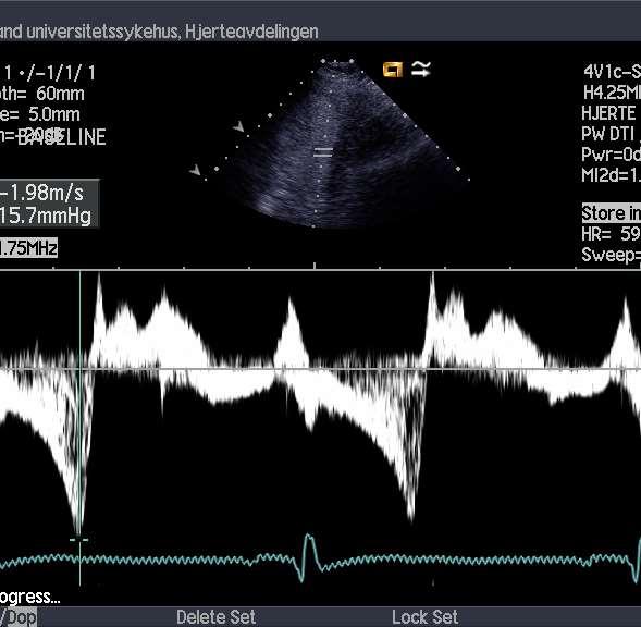 Ekkokardiografi HOCM-SAM M-mode SAM