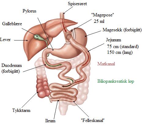 Figur 2: Oversikt over mage og tarm etter gastric bypass operasjon.