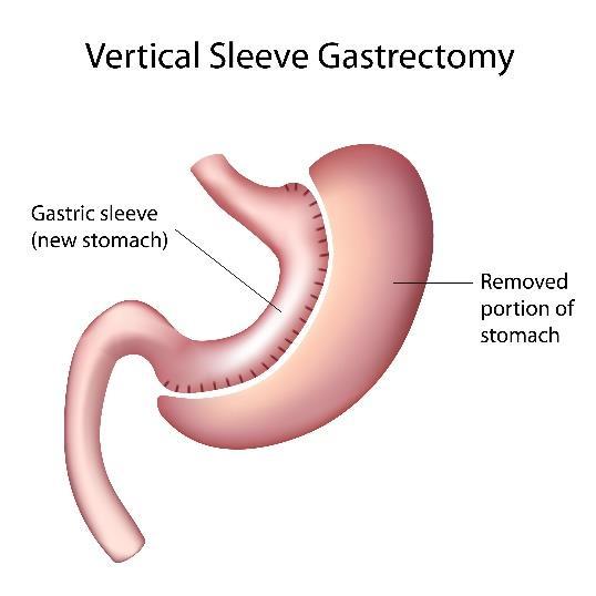 Figur 2 Gastric sleeve (fra Shutterstock) Bileopankreatisk avledning med duodenal omkopling (biliopancreatic diversion with duodenal switch) (figur 3), ofte forkortet som duodenal