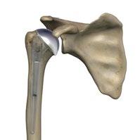 Skulderproteser; ulike typer Totalprotese (helprotese) Ved stor bruskslitasje i skulderen med bevart muskel/senemansjett velges en totalprotese, det vil si at det settes inn kunstig leddhode og